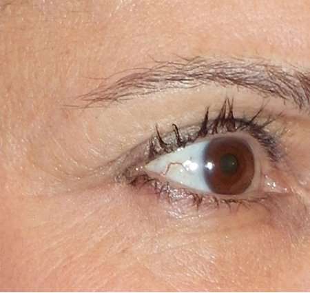 Fractora Before & After Patient #99