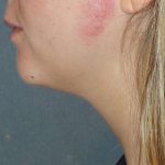Neck Liposuction Before & After Patient #75