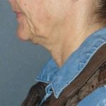 Fractora Before & After Patient #102