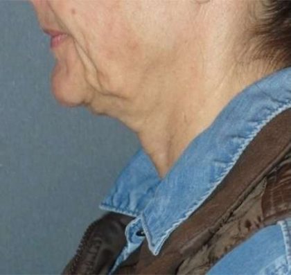 Fractora Before & After Patient #102