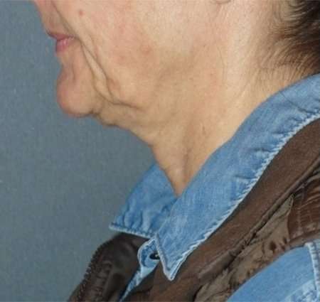 Fractora Before & After Patient #102