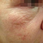 Fractora Before & After Patient #105