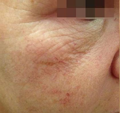 Fractora Before & After Patient #105