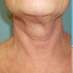 Fractora Before & After Patient #108