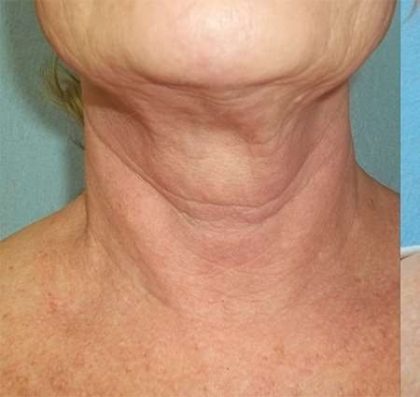 Fractora Before & After Patient #108