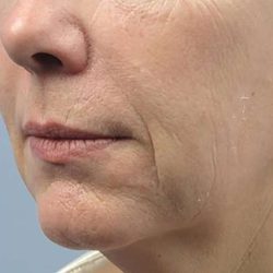 Forma Before & After Patient #111