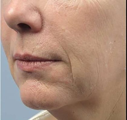 Forma Before & After Patient #111