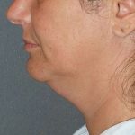 Facetite Before & After Patient #114