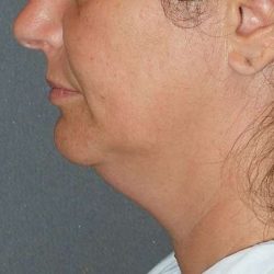 Facetite Before & After Patient #114