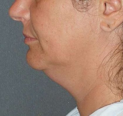 Facetite Before & After Patient #114