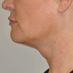 Facetite Before & After Patient #117