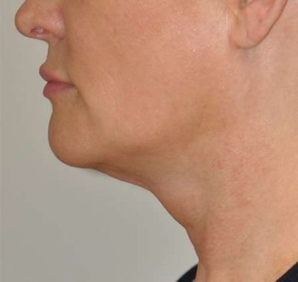 Facetite Before & After Patient #117