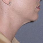 Necklift Before & After Patient #78