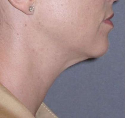 Necklift Before & After Patient #78