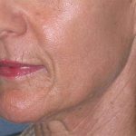 Liquid Lift Before & After Patient #90