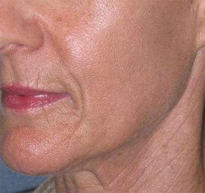 Liquid Lift Before & After Patient #90