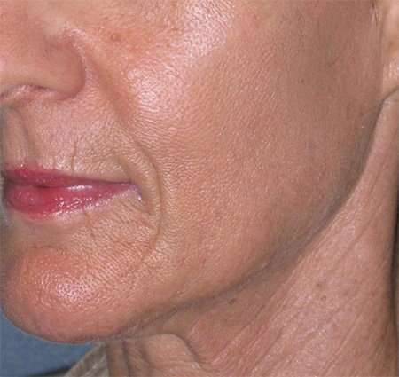 Liquid Lift Before & After Patient #90