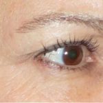 Fractora Before & After Patient #99