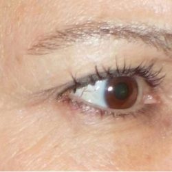 Fractora Before & After Patient #99