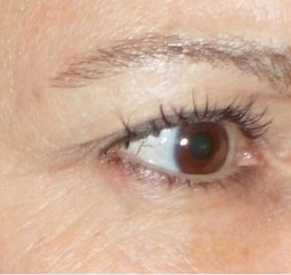 Fractora Before & After Patient #99