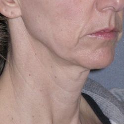 Mini Lift Before & After Patient #87