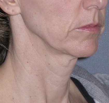 Mini Lift Before & After Patient #87