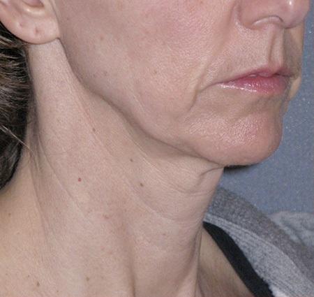Mini Lift Before & After Patient #87