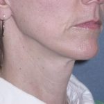 Mini Lift Before & After Patient #87