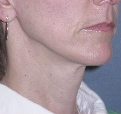 Mini Lift Before & After Patient #87