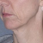Mini Lift Before & After Patient #87
