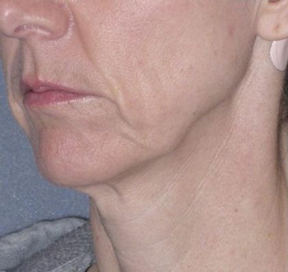 Mini Lift Before & After Patient #87