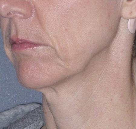 Mini Lift Before & After Patient #87