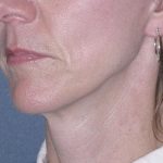 Mini Lift Before & After Patient #87