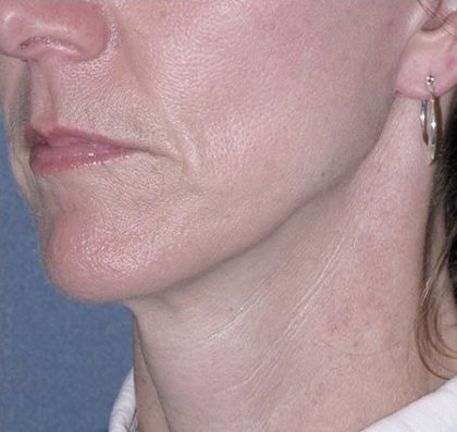 Mini Lift Before & After Patient #87