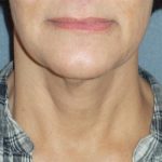 Mini With Necklift Before & After Patient #84