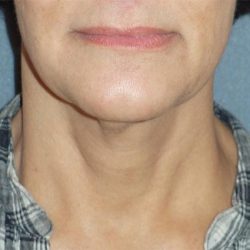 Mini With Necklift Before & After Patient #84