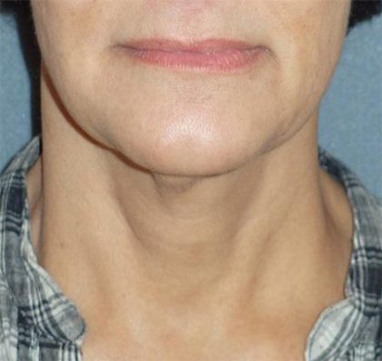 Mini With Necklift Before & After Patient #84