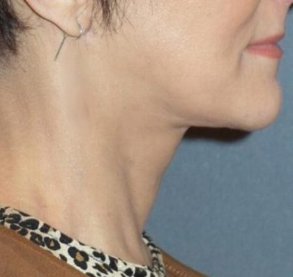 Mini With Necklift Before & After Patient #84