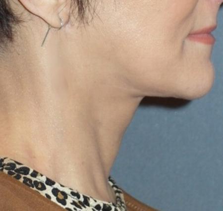 Mini With Necklift Before & After Patient #84