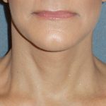 Mini With Necklift Before & After Patient #84