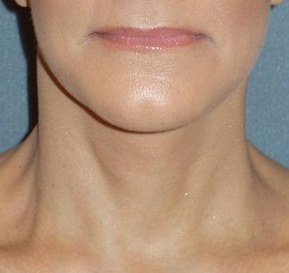 Mini With Necklift Before & After Patient #84