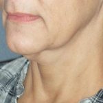 Mini With Necklift Before & After Patient #84