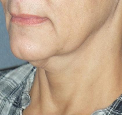 Mini With Necklift Before & After Patient #84