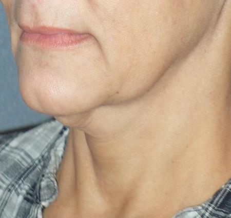 Mini With Necklift Before & After Patient #84