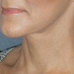 Mini With Necklift Before & After Patient #84