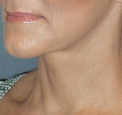 Mini With Necklift Before & After Patient #84