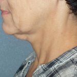 Mini With Necklift Before & After Patient #84
