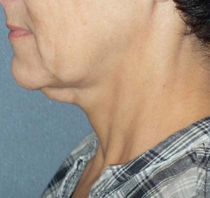 Mini With Necklift Before & After Patient #84
