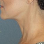 Mini With Necklift Before & After Patient #84