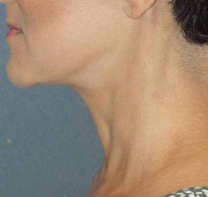 Mini With Necklift Before & After Patient #84